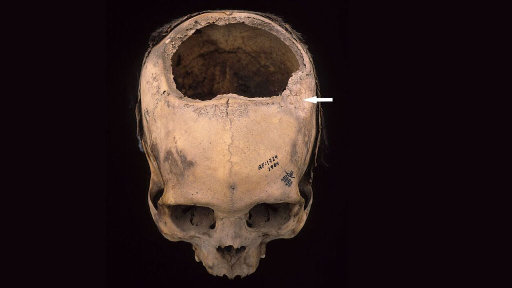 How the Incas Performed Skull Surgery More Successfully Than U.S. Civil War Doctors How the Incas Performed Skull Surgery More Successfully Than U.S. Civil War Doctors